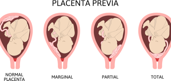 Placenta Praevia – Fehllage des Mutterkuchens