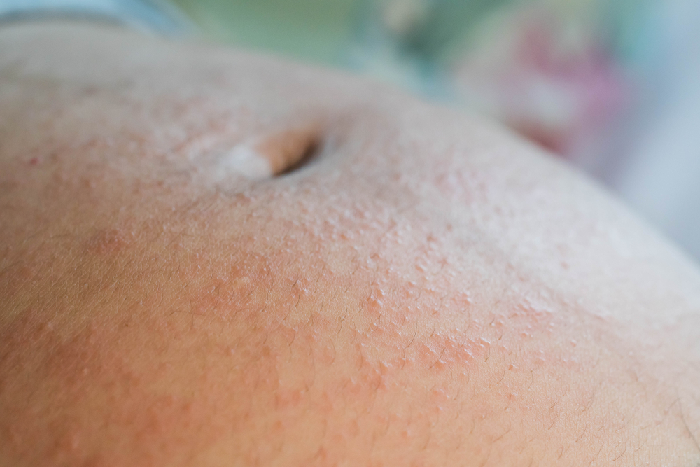 Schwangerschaftsdermatose – Arten und Behandlung