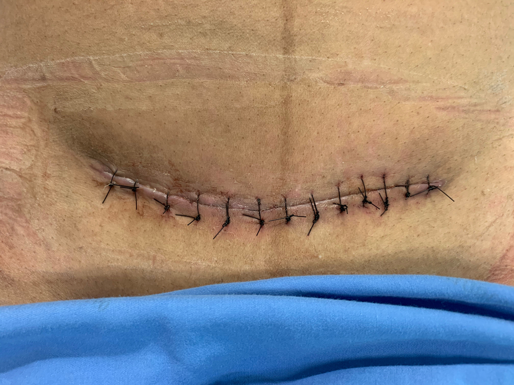 Pfannenstiel,Surgical,Incision,With,Suture