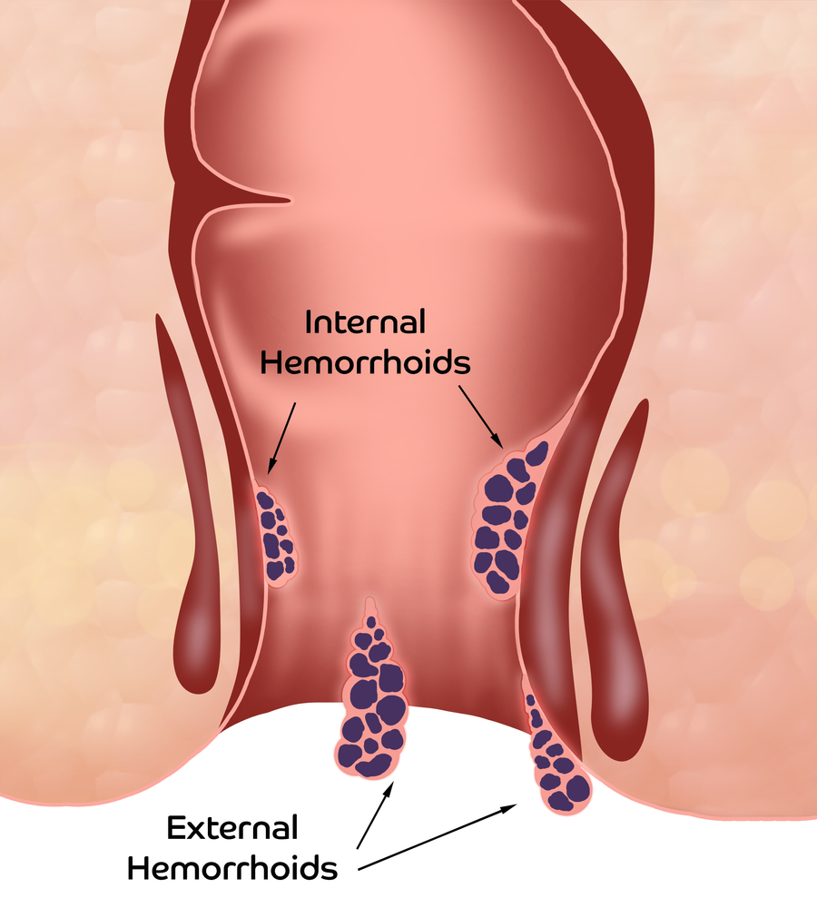 Hemorrhoid.,Unhealthy,Lower,Rectum,With,Inflamed,Vascular,Structures,,Illustration