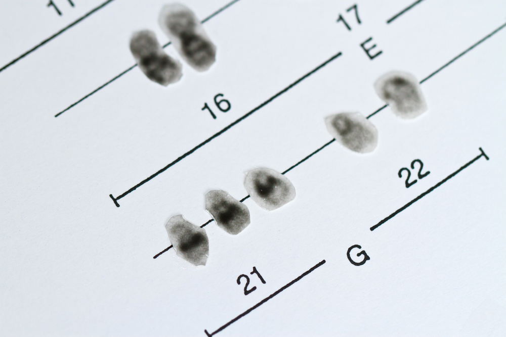 Chromosomes,21,,Trisomy,21,,Down,Syndrome